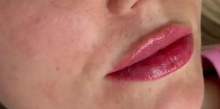 Preenchimento labial Depois